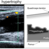 変形性膝関節症の滑膜異常に対する超音波エコーの適応　−横断研究−
