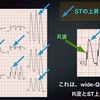 ECG-171：answer(2/2)