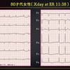 ECG-310：80才代女性。心不全発作での搬入です。