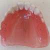 ３Dプリントデンチャーの歯肉・歯冠をズレなく接着するために①モノリシック、簡易咬合器でずれのない接着を