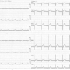 ECG-142：answer