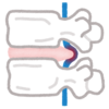 ヘルニアとかいう一見ザコっぽい名前なのにラスボス級の攻撃力を持っている病気