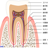 治したところがまた虫歯になるのはなんで？