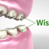 What is Wisdom Teeth and How Do I Know if I Have Wisdom Teeth?