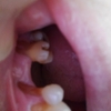 斜歯の歯茎