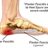 What Will Cause Pain Of The Heel And The Ways To Alleviate It