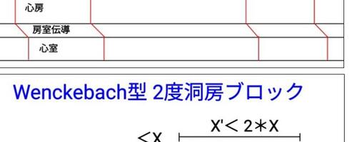 RR間隔が不整なら「基本調律を探せ」・・・洞房ブロックにPACが絡まった例