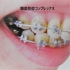 歯科矯正21約４ヵ月で歯のアーチに変化