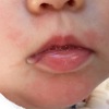 赤ちゃんの豆腐 大豆 アレルギー 次女に症状が出ました 画像あり 離乳食の記録ブログ
