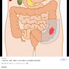 便秘S字結腸呼吸法