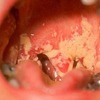 Bệnh lậu ở miệng: Nguyên nhân, biến chứng và hướng điều trị