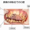 歯根膜反射を使った咀嚼運動の賦活の話とＨＰの新しいページ