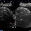 エコーで腹水を見る。膵臓の周りにあるのは腹水ですか？？と聞かれて。。腹部エコー検査。腹水。