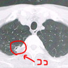 二度目の診察で人生初のCT。結節が見つかる。
