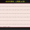 ECG-337：60才代男性。いきなりの持続する胸痛でした。