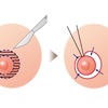 乳輪乳頭縮小術しました