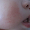 乳児湿疹　その10・汗疹