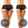 Buttock liposuction – Important things you need to know!