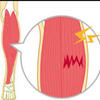 ふくらはぎの痛みについて。