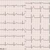 【コラム-019】正常心電図03＝(18誘導+1)：44才男性。
