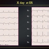 ECG-399：80代男性。昨日からの胸部不快感です。