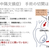 心室中隔欠損症(VSD)の孔の位置について〜看護師より小児循環器医に必要な知識　右室の解剖から　疾患21