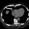 case136：CT室で胸部圧迫感が出現した78歳男性（Ann Emerg Med. 2021 Apr;77(4):415-467.）