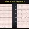 ECG-279：80才代女性。入院中の突然の胸痛です。