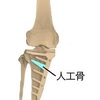 高位脛骨骨切り術 -入院と手術と（その４）