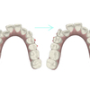 痛みで目が覚めたインビザライン2日目　#1/26