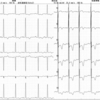 ECG-074：85才女性。一発診断して下さい。