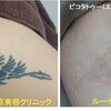 大腿の黒くべったりと濃いタトゥーが目立たなくなりました