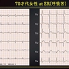 ECG-253：70才代女性。１週間前からの呼吸苦です。