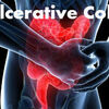 Ulcerative Colitis Market Forecast, Insights and Epidemiology 2023