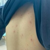【自閉症児】全身に発疹ができる