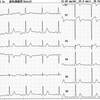 ECG-098：54才男性。胸部不快感持続で大晦日にERへ。