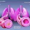 Asthma Is A Quiet Killer That Is Caused By Odors