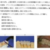 114回　歯冠補綴学振り返り　硬質レジンブリッジ編