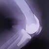 人工関節の膝の手術して6年目