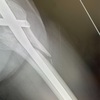股関節骨折(大腿骨転子部) 8ヶ月経過