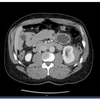 症例120：左側腹部痛と血尿のため受診した50歳男性（Am J Emerg Med. 2021 Feb;40:225.e1-225.e2.）