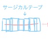 【1回目】帝王切開の傷について