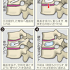 背骨の骨折、風船で治す