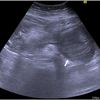 症例51：上腹部痛を訴える膵炎既往がある67歳女性（Ann Emerg Med. 2021 Jan;77(1):e60-e61.）