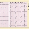 ECG-190:60才代男性。健診での心電図がQRS幅>0.12秒でIRBBB???