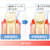 歯周病が全身病の原因！ ～歯周病を改善する方法とは！？～