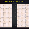 ECG-305：70才代女性。突然の喉の痛みと呂律不良です。