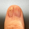 グロームス腫瘍摘出手術：術後279日目。爪の中の黒い点（おそらく血）がだいぶ上に移動してきた