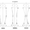 Overpronation Of The Foot