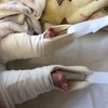 先天性股関節脱臼